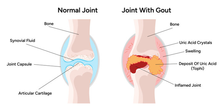 Medical infographic the gout arthritis and normal joints