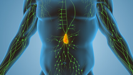 Cancer of the lymphatic system caused by lymphomas