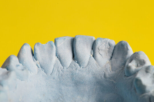 Blue plaster impression of a patient's dental jaw with crooked teeth and malocclusions on a yellow background. Manufacturing of braces to correct bite. View from above. Copy space for text
