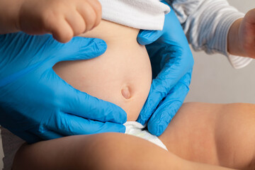 Doctor's hands in blue medical gloves examine an umbilical hernia in a child, close-up. Treatment...