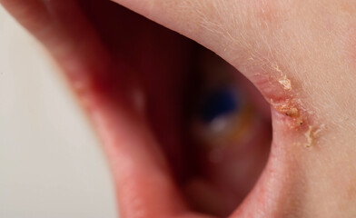 Seizures on the corners of the lips of a child s mouth. Bacterial disease of inflammation of the...