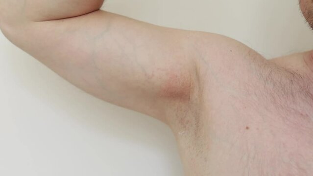 Armpit rash. Cropped photo of irritation, inflammation on sensitive underarm skin after using toxic deodorant or antiperspirant. Allergy, atopic dermatitis. Acne or red spots. Shaving effect.
