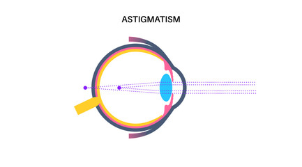 Astigmatism eye disease