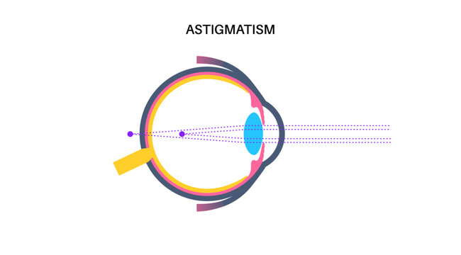 Astigmatism eye disease