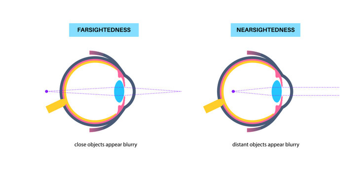 Farsightedness and nearsightedness