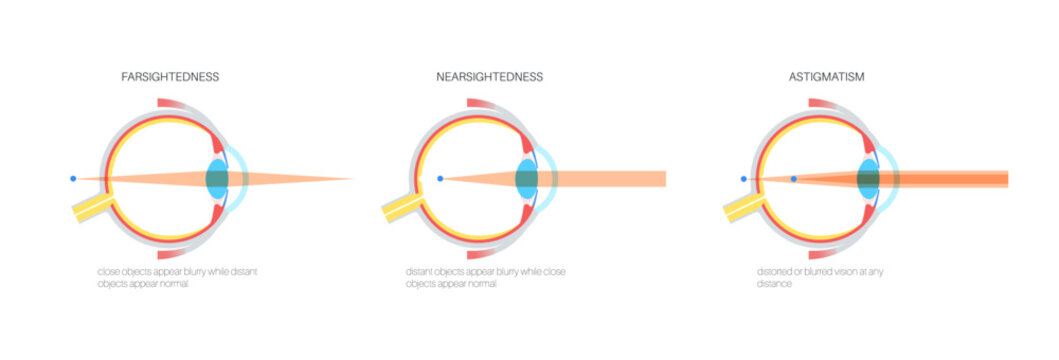 Farsightedness and nearsightedness