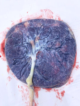 A placenta with umbilical cord on a white table after birth