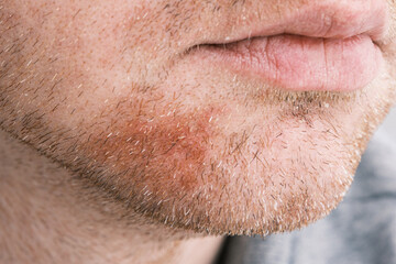 Seborrheic dermatitis or eczema on adult man face close up.	