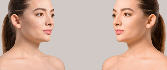 Young woman before and after acne treatment on light background