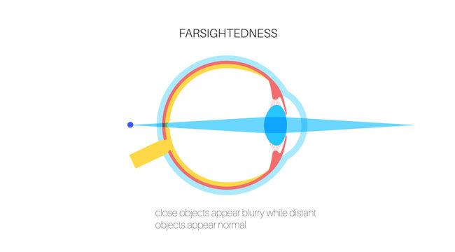Farsightedness eye disease