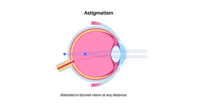 Astigmatism eye disease