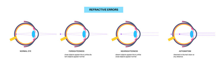 Refractive errors poster