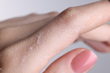 Woman with dry skin on hand against light background, macro view