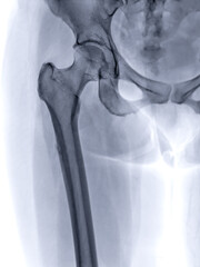 An X-ray reveals both hip joints in normal study.