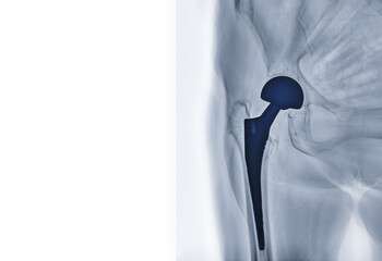 Fototapeta premium An X-ray reveals both hip joints with TOTAL HIP ARTHROPLASTY, showcasing the success of the surgical procedure and providing a visual testament to the restored mobility and function.