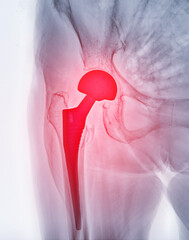 An X-ray reveals both hip joints with TOTAL HIP ARTHROPLASTY, showcasing the success of the...
