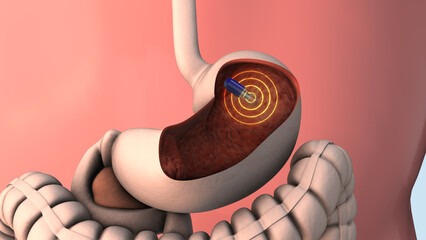 Capsule endoscopy and wireless communication	
