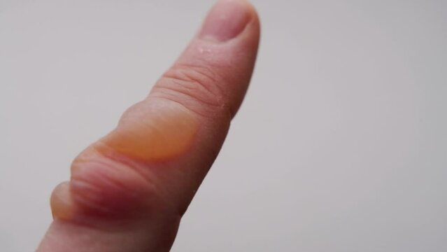 Thermal burn on a finger with a blister on a white background. Burn treatment concept, degree of burn, close-up. Copy space for text