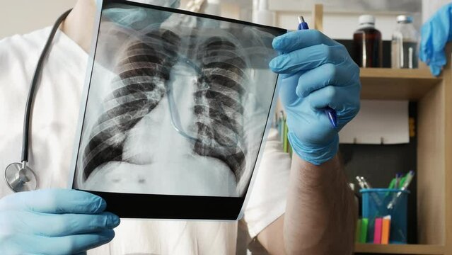 A doctor diagnoses the disease lung cancer in the office, a radiologist examines an x-ray of the lungs of an elderly person in the hospital