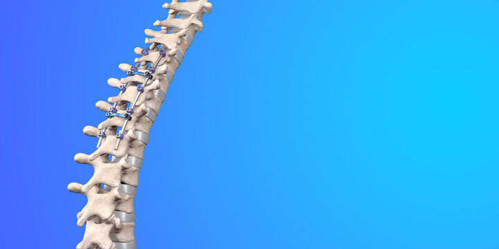 Spine Posterior Thoracic Fusion with Pedicle Screws and Rods on Blue Background