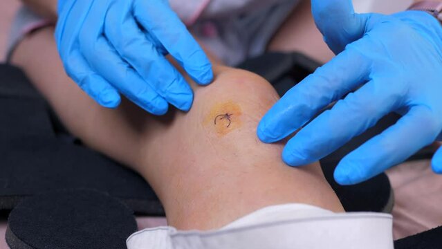 Close-up of a doctor hands in medical gloves examining a patient's operated knee. Surgery of the meniscus and cruciate ligament. Concept of rehabilitation of patients after surgery