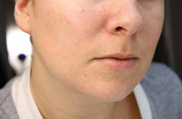 Fototapeta premium Close up of caucasian woman's face with scars, acne skin problems