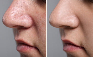 Blackhead treatment, before and after. Collage with photos of woman on grey background, closeup view