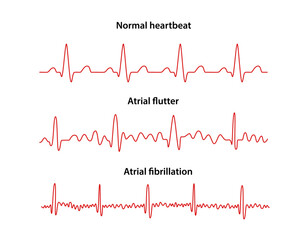 Diagram of normal rhythm, Atrial flutter and Atrial fibrillation for a human heart. Heart cardiogram. Vector illustration in flat style isolated on white background - obrazy, fototapety, plakaty