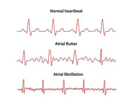 Diagram of normal rhythm, Atrial flutter and Atrial fibrillation for a human heart. Heart cardiogram. Vector illustration in flat style isolated on white background