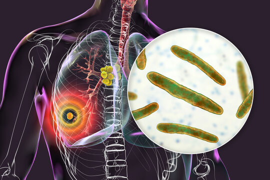Primary lung tuberculosis, 3D illustration