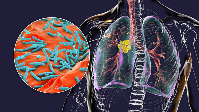 Primary lung tuberculosis, 3D illustration