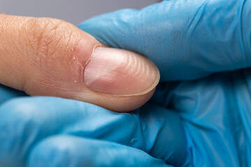 Doctor in gloves examining a ridged fingernails with vertical and horizontal ridges. Nails problems