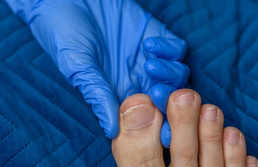 Lekarz dermatolog bada grzybicę stóp, łuszczyca paznokci  - obrazy, fototapety, plakaty