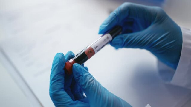 Lab assistant checking blood tube with positive HIV test result, taking notes