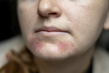 Perioral dermatitis on woman face. Closeup dermatitis on skin, ill allergic rash eczema skin of patient, atopic dermatitis symptom skin detail texture. The concept dermatology - obrazy, fototapety, plakaty