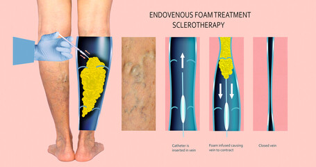 Endovenous laser treatment for varicose veins - foam sclerotherapy concept. - obrazy, fototapety, plakaty