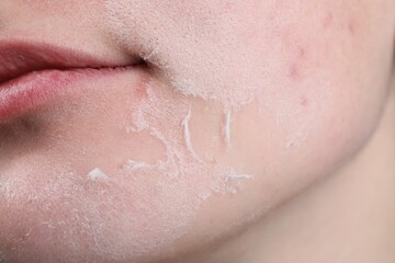 Woman with dry skin on face, closeup
