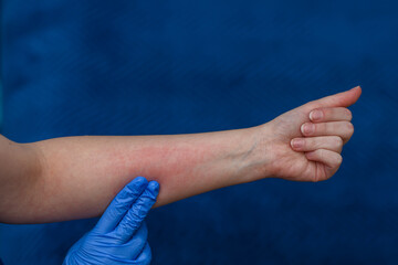 Ręka z zaczerwienioną skórą, alergia kontaktowa 