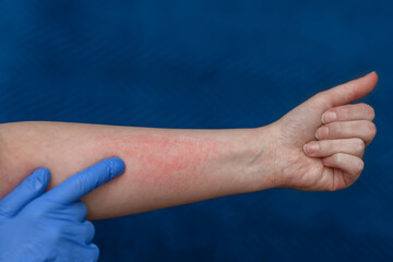 Ręka z podrażnieniem alergicznym, zaczerwiona skóra przedramienia - obrazy, fototapety, plakaty