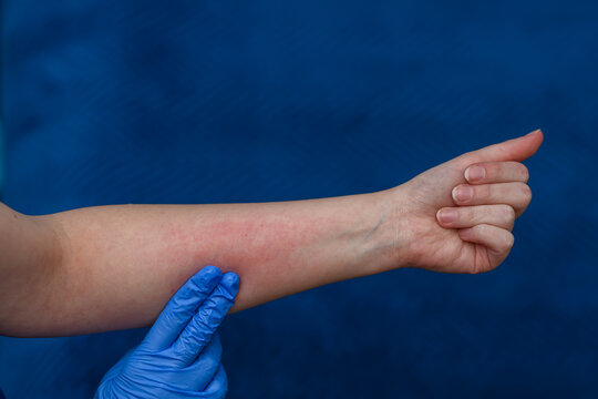 Ręka z zaczerwienioną sk&oacute;rą, alergia kontaktowa 