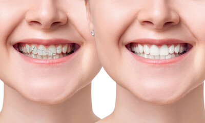 Fototapeta premium Young woman smiling before and after teeth treatment.