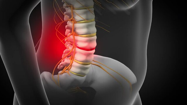 Back Pain, could be caused by spinal disc herniation / slipped disc. 3d animation