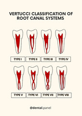 Root Canal Systems (Vertucci Classification)