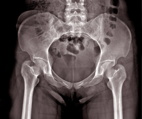 X-ray image of a young woman with hip pain