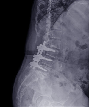 Anterior and lateral L-S spine X-ray images after herniated disc surgery