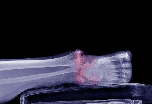 X-ray image of a severely broken ankle according to the doctor's diagnosis.