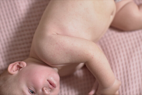 Roseola of the course of the disease in the baby, rash on the skin, the baby is capricious and sluggish