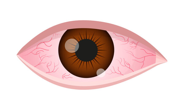 Dry eye syndrome. Inflamed bloodshot eyeball with swelling, irritation and red conjunctiva. Symptoms of infection, allergy, keratitis, blepharitis, conjunctivitis, uveitis. Vector cartoon illustration