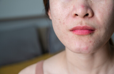 Cropped shot view of woman face with acne problem.