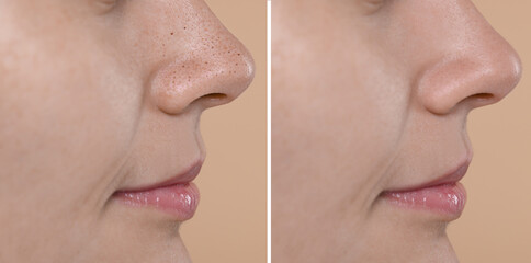Blackhead treatment, before and after. Collage with photos of woman on beige background, closeup...